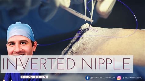 newly inverted nipple|Article: Newly Inverted Nipples: What Are the。